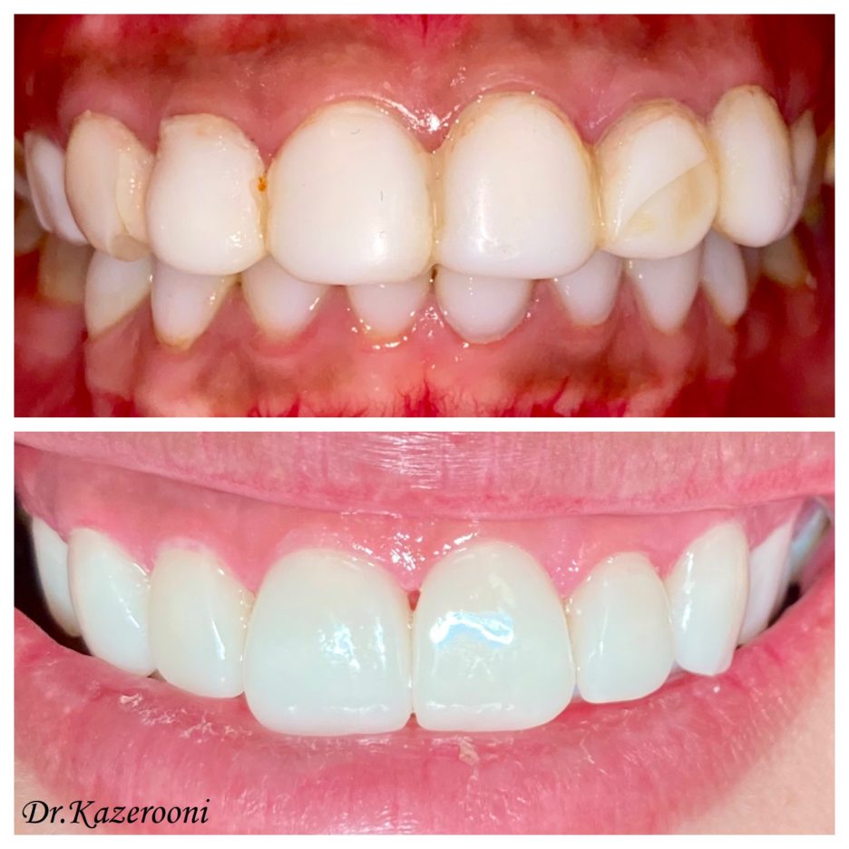 dental reference 14, before, after, Budapest, hollan dent
