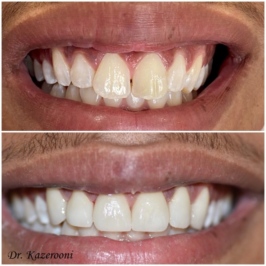 dental reference 10, before, after, Budapest, hollan dent
