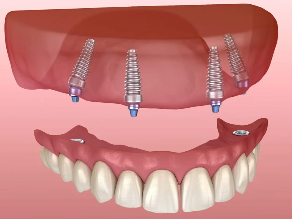 Fix fogsor – Implantátumokkal
